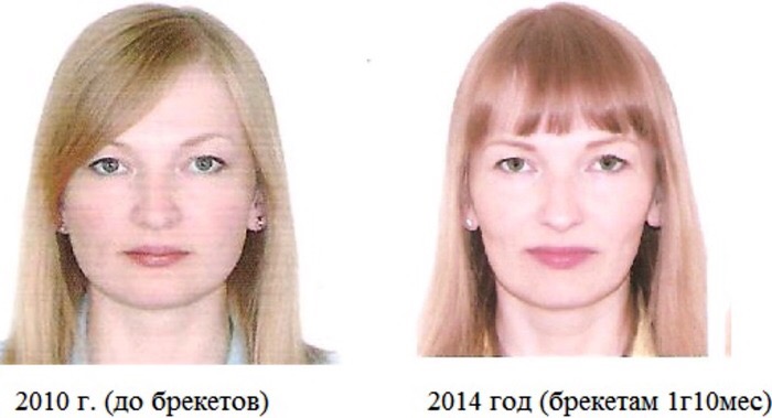 braces, change, face