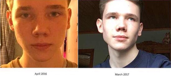 Příklady miofunkční korekce