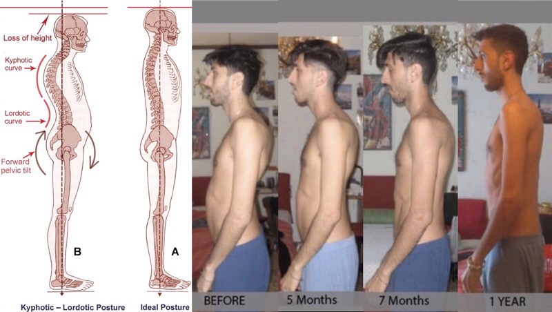 Bederní lordóza: jak ji léčit biomechanicky
