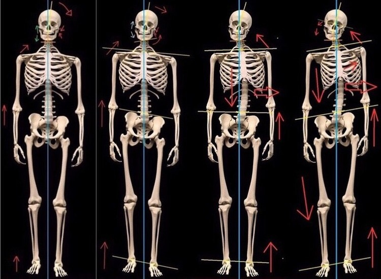 Skoliosis: Cara Melewati Tahapannya dalam Urutan Terbalik. Pendekatan Biomekanis
