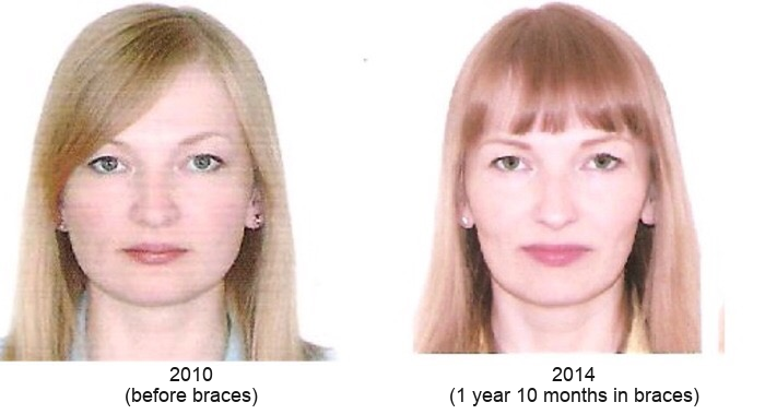 aparat dentar fix, schimbare, față