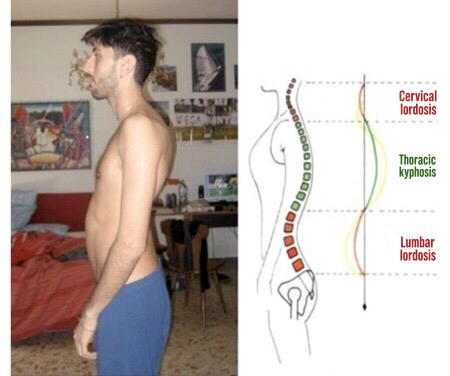 Ilustracja do sekcji „Lordoza lędźwiowa: jak leczyć ją biomechanicznie”