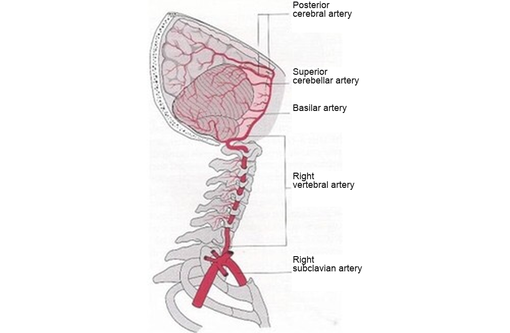 vertebra, arteri, sindrom, anomali, kimmerle
