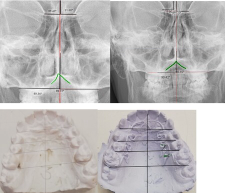 Kılavuz çizgileri içeren iki önden röntgen görüntüsü ve iki diş modeli