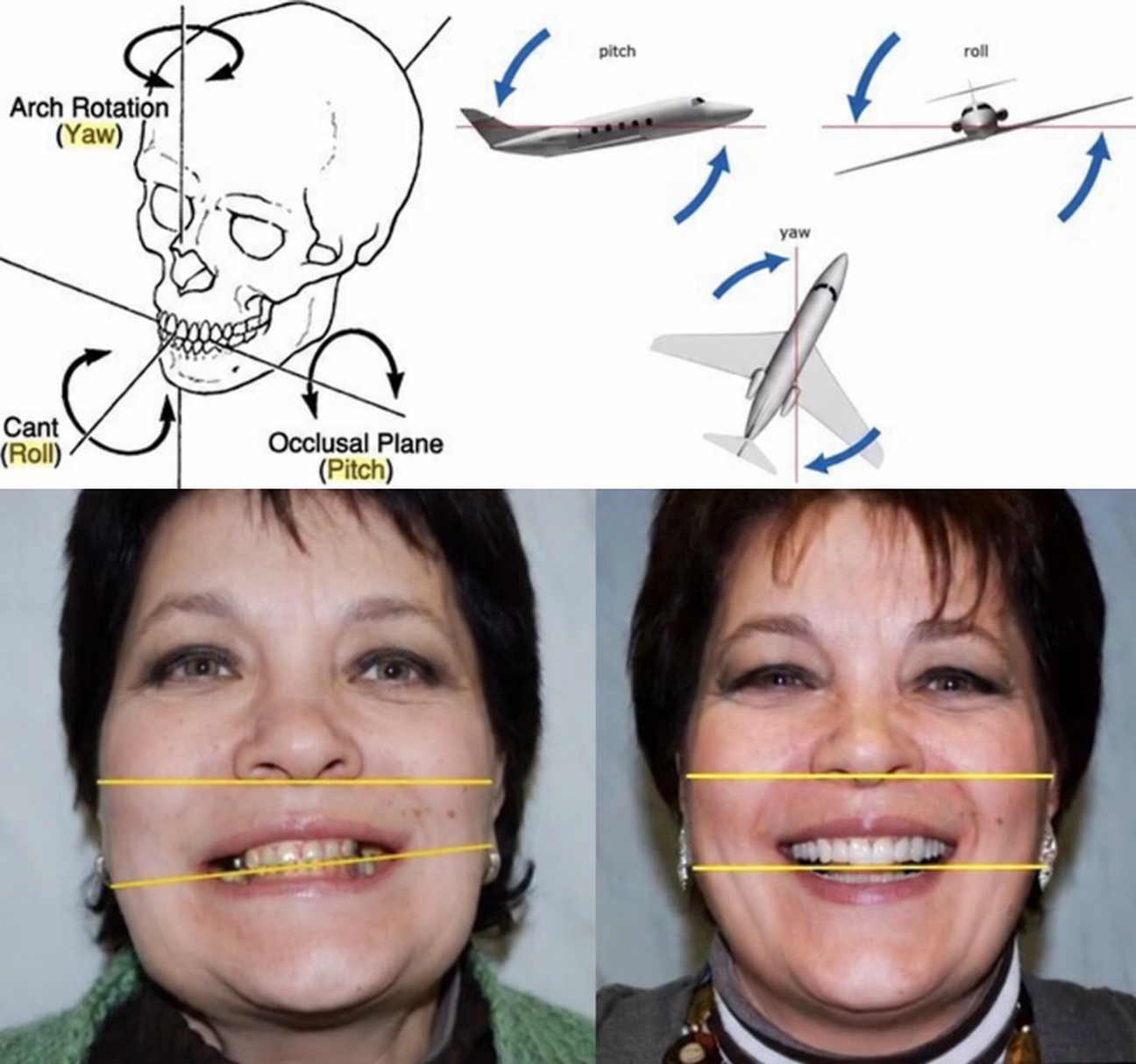Kolaj: kafatası şeması, oklarla uçaklar ve sarı çizgilerle iki yüz fotoğrafı.