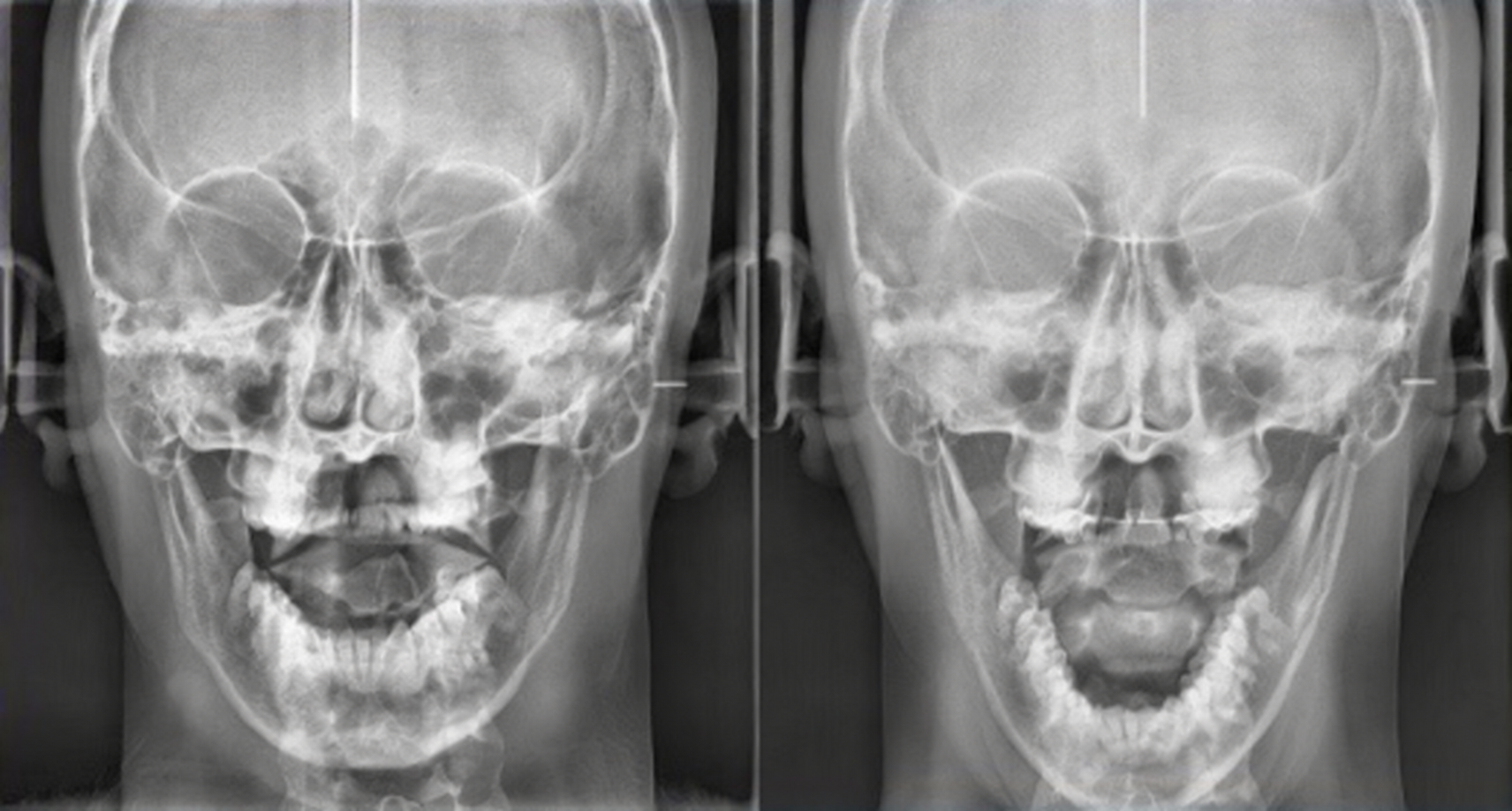 Duas radiografias frontais do crânio lado a lado com a marca original Sleep & TMJ
